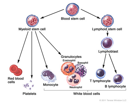Acute Lymphoblastic Leukemia ALL