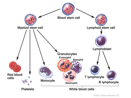 Acute Myeloid Leukemia AML